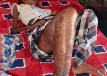 A 11 ans, Aïssatou Diallo souffre d’une malformation de la jambe, sa mère lance un sos